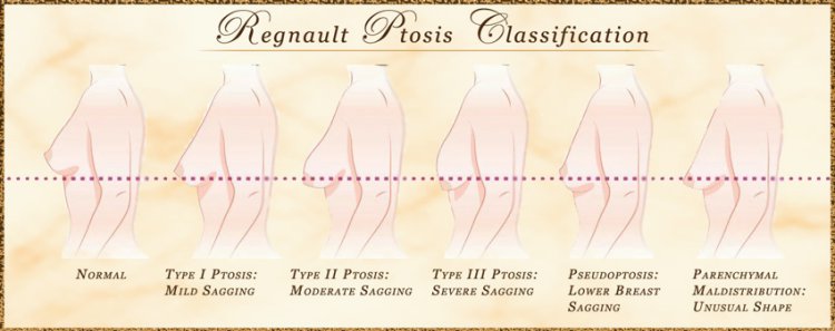 Regnault Classification Breast Ptosis