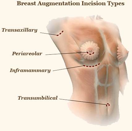 Types of Breast augmentation incisions - Cosmeticsurg