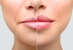 lip-enhancement-london-sheffield