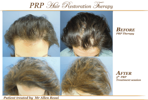 Before-and-after-PRP-1