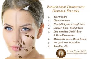 dermal-filler-diagram-web