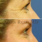 10-CrowsFeet Treated with Botox and Slight Lateral Brow Lift