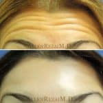 11-Forehead Lines Treated with Botox
