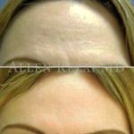 13-Overall upper face Rejuvenation with Botox