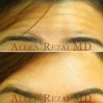 4-Forehead Lines Treated with Botox