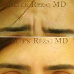 7-Frown (Glabella) Lines Treated with Botox