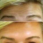 8-Forehead Lines Treated with Botox