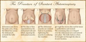 procedure of abdominoplasty