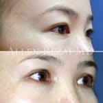 21-Double-Eyelid-Surgery---Asian-Blepharoplasty