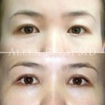 22-Double-Eyelid-Surgery---Asian-Blepharoplasty