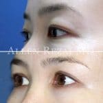 23-Double-Eyelid-Surgery---Asian-Blepharoplasty