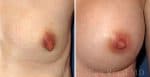 5-nipple-reduction