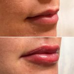 lips-july1