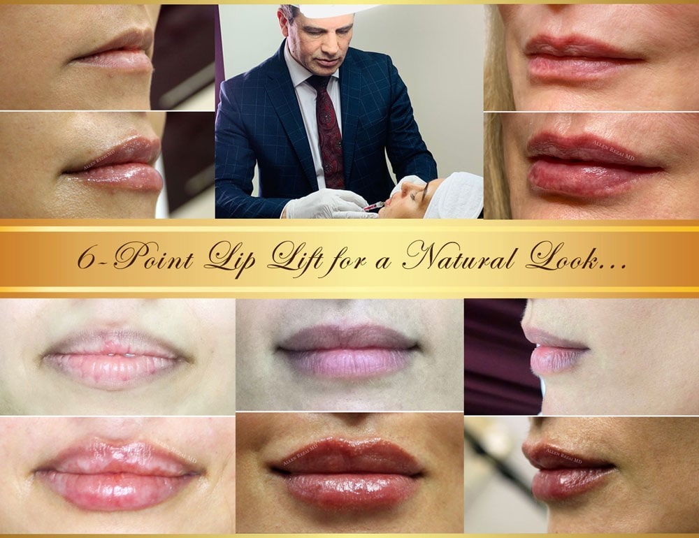 6-point lip lift