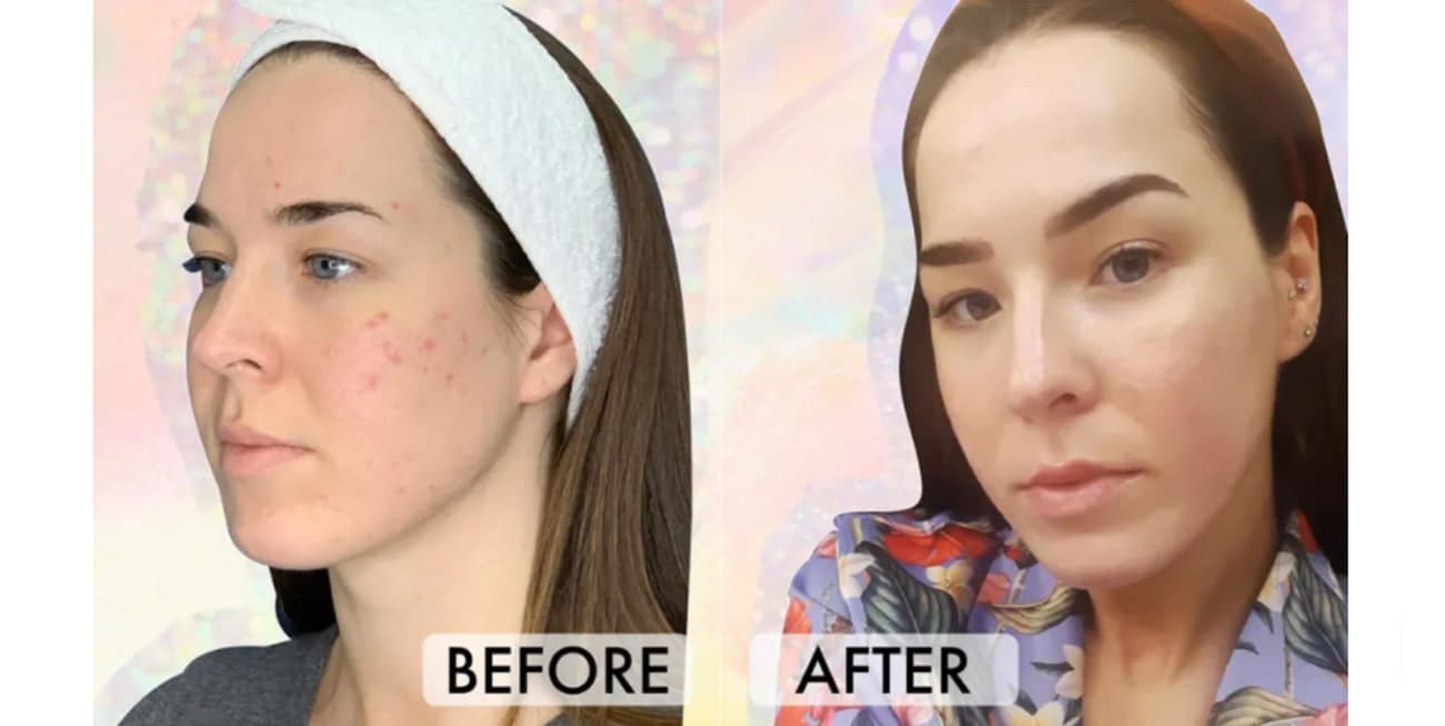 PRP (The Vampire Facial) Transformed Our Skin On Another Level