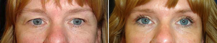 Upper eyelid surgery