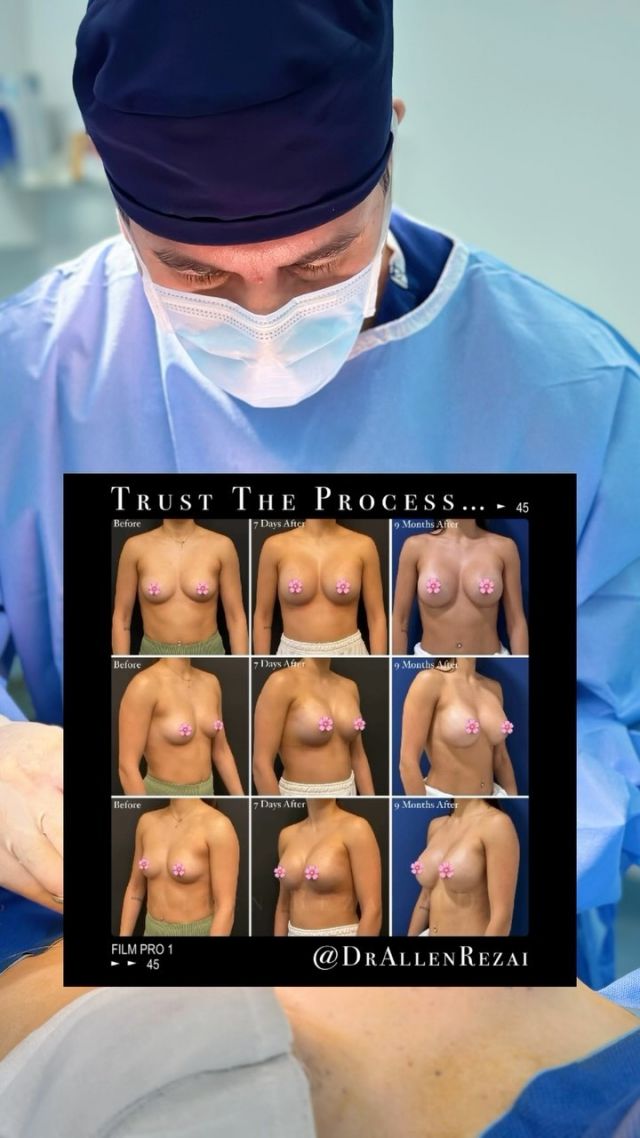 Step by Step Unveiling the Procedure for a Breast Lift