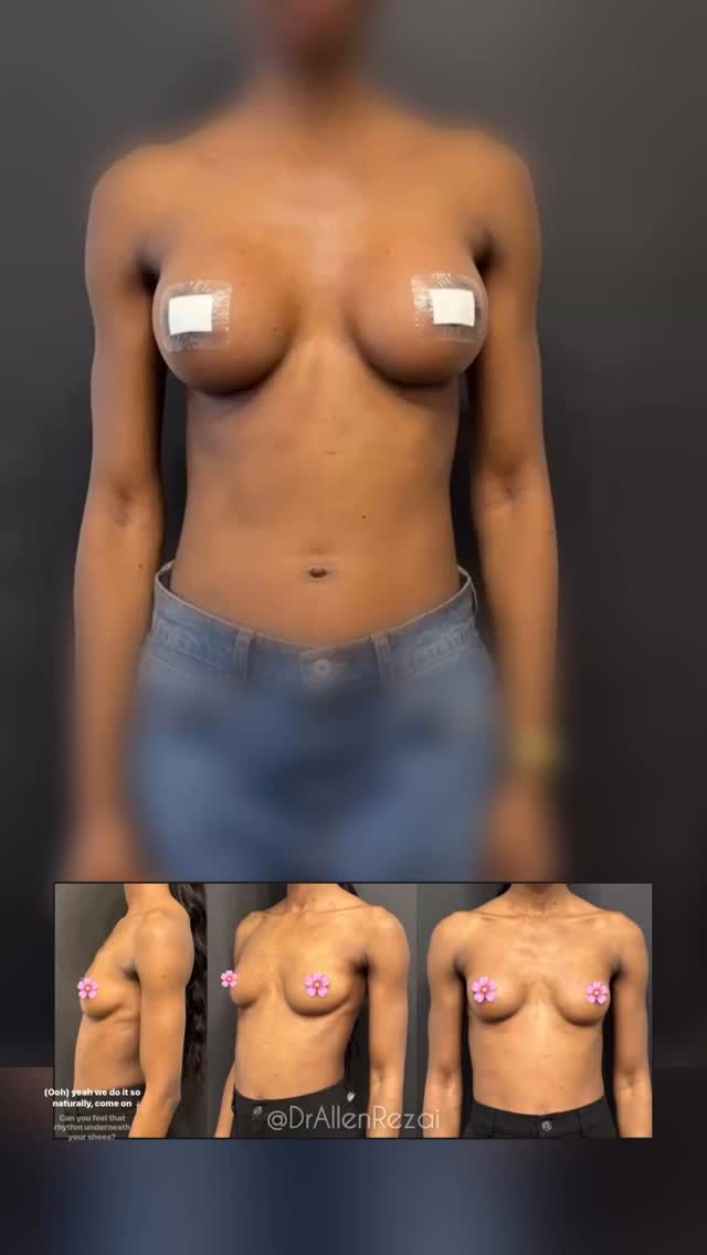 // TRANSFORMING LIVES through Bespoke “Natural Look” Breast Augmentation 🫶🏻 #NaturalLook #NaturalResults 
Implants continue to settle and look even more natural during the next few months… Stay tuned!
Detailed Consultation, Correct Implant Selection & Surgical Planning are key in achieving natural results and the best possible outcome for You...
⚜️For Enquiries DM or Call Your Preferred Clinic:
.
👉🏻🇦🇪 Dubai @EliteClinicDubai 
📞+971 (0)4431 2396 
.
👉🏻🇬🇧 London & East Sussex @DrAllenRezai 
👉🏻 SkinCare @SkinCision_Clinic 
📞+44 (0)20 7580 8001