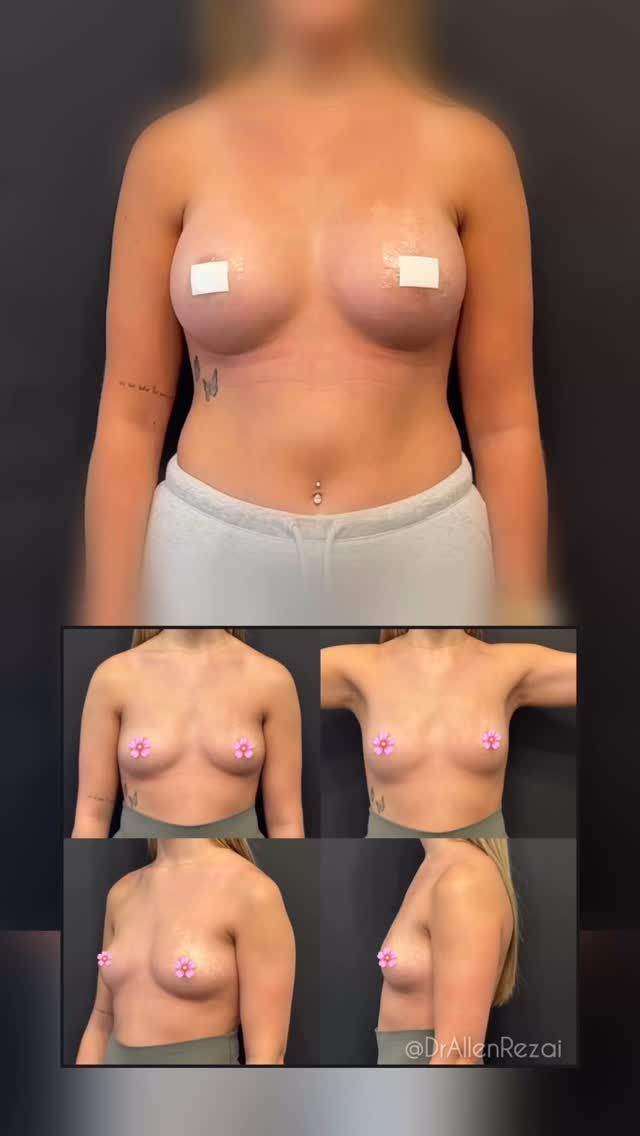 // 6 WEEKS AFTER Bespoke “Natural Look” Breast Augmentation… #NaturalLook #NaturalResults #DrAllenRezai
Detailed Consultation, Correct Implant Selection & Surgical Planning are key in achieving natural results and the best possible outcome for You...
⚜️For Enquiries:
.
👉🏻DM @DrAllenRezai 
📞+44 (0)20 7580 8001
📧 Info@AllenRezaiMD.co.uk
#PlasticSurgery #BeforeAndAfter #plasticsurgeon #plasticsurgerybeforeandafter #breastaugmentation