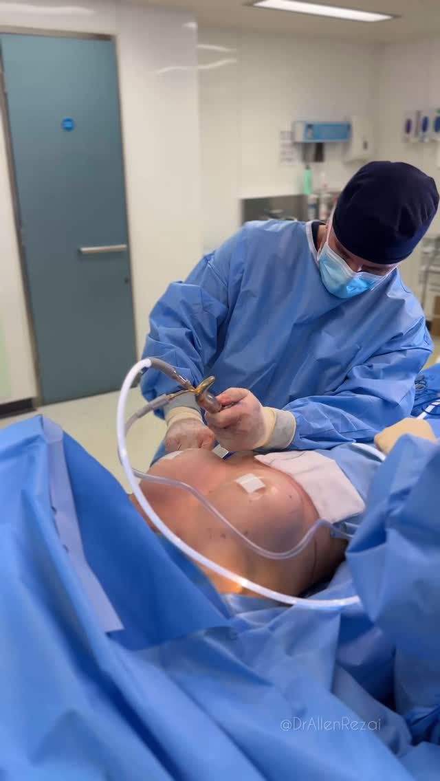 // 4 WEEKS AFTER Bespoke “Natural Look” Breast Augmentation… #NaturalLook #NaturalResults #DrAllenRezai
Detailed Consultation, Correct Implant Selection & Surgical Planning are key in achieving natural results and the best possible outcome for You...
⚜️For Enquiries DM or Call Your Preferred Clinic:
.
👉🏻🇦🇪 Dubai @EliteClinicDubai 
📞+971 (0)4431 2396 
.
👉🏻🇬🇧 London & East Sussex @DrAllenRezai 
👉🏻 SkinCare @SkinCision_Clinic 
📞+44 (0)20 7580 8001
#plasticsurgery #plasticsurgerybeforeandafter #beforeandafter #plasticsurgeon #