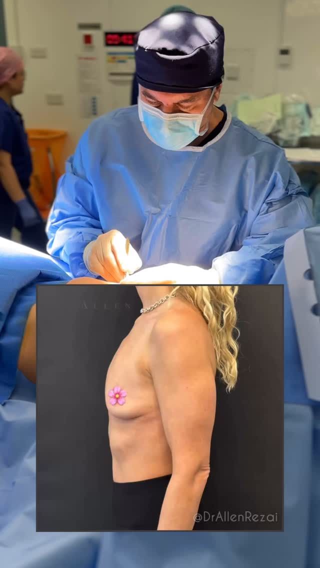 // 6 WEEKS AFTER Bespoke “Natural Look” Breast Augmentation… #NaturalLook #NaturalResults
Implants continue to settle and look even more Natural over the coming months…
Detailed Consultation, Correct Implant Selection & Surgical Planning are key in achieving natural results and the best possible outcome for You...
⚜️For Enquiries DM or Call Your Preferred Clinic:
.
👉🏻🇦🇪 Dubai @EliteClinicDubai 
📞+971 (0)4431 2396 
.
👉🏻🇬🇧 London & East Sussex @DrAllenRezai 
👉🏻 SkinCare @SkinCision_Clinic 
📞+44 (0)20 7580 8001